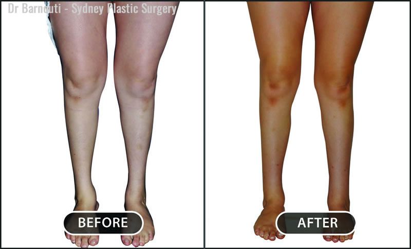 Calves Before And After